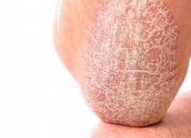 Dry skin on elbows: what is the cause and how to treat