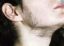 Årsager til uønsket hårvækst og måder at fjerne det på